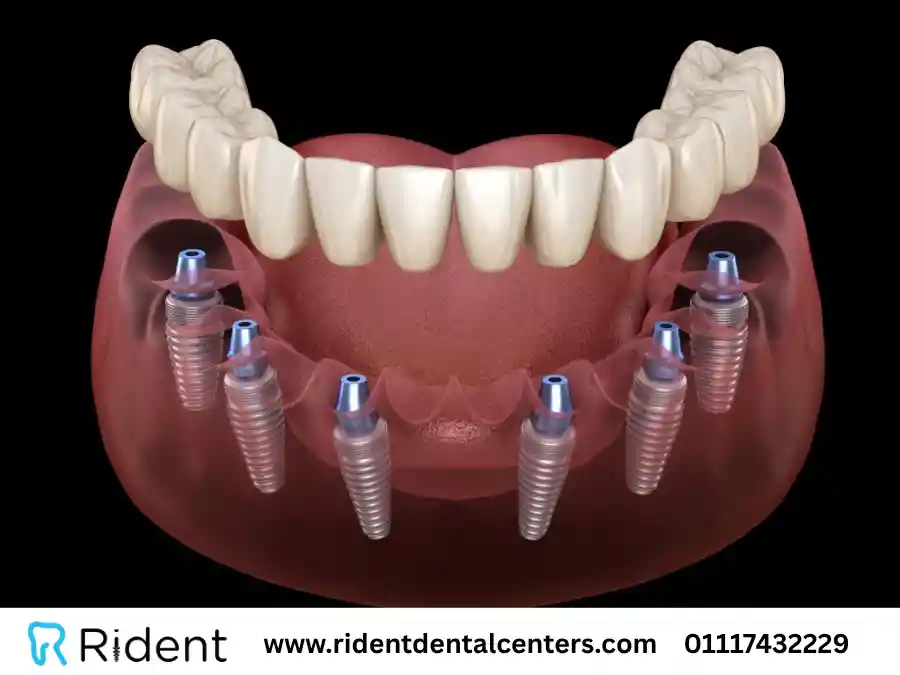 زراعة الأسنان&nbsp;all on 6